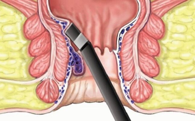 coagulation of hemorrhoids in hemorrhoids